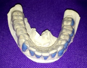 Blanchiment des dents Empreinte