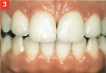 Traitement diastème facette dentaire dentiste Amouyal Paris 16