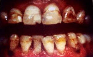 Transformation dents jaunes colorées facette dentaire dentiste Paris 16