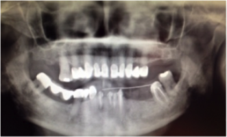 implants dentaires dentiste paris