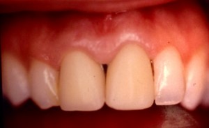 dents provisoires