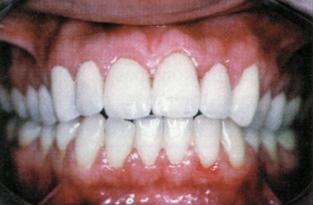 facettes dentaires céramique dentiste richard amouyal paris 16