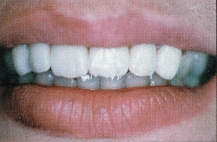 facettes dentaires céramique dentiste richard amouyal paris 16