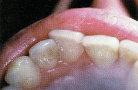 Traitement diastème facette dentaire dentiste richard amouyal paris 16