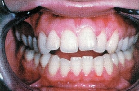 Traitement diastème facette dentaire dentiste richard amouyal paris 16