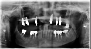 Après 6 mois de cicatrisation Pose implants dentaires dentiste richard amouyal Paris 16