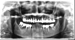Cas de départ Pose implants dentaires dentiste richard amouyal Paris 16