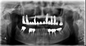 Résultat final du bridge complet en céramique de 13 éléments Pose implants dentaires dentiste richard amouyal Paris 16