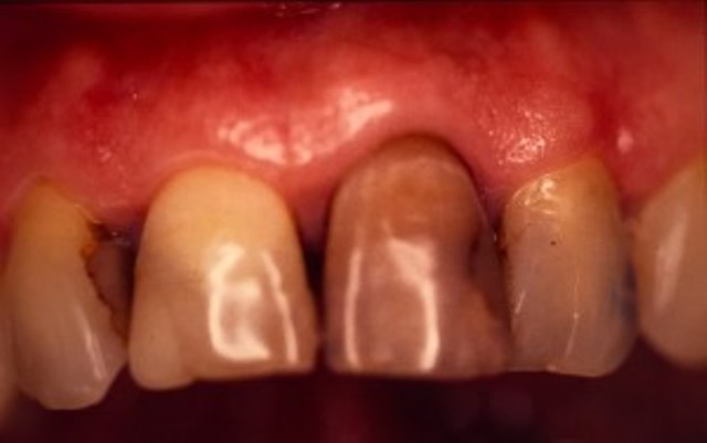 dents jaunes couronnes céramique dentiste richard amouyal