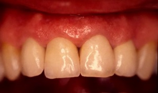 dents jaunes couronnes dentaires dentiste richard amouyal