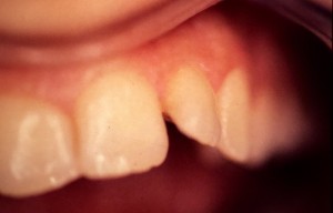 Correction d’une anomalie des dents par facette en céramique