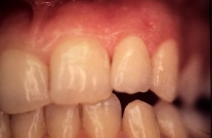 Correction d’une anomalie des dents par facette en céramique