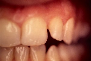 Correction d’une anomalie de forme et de position des dents par facette en céramique
