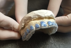 Gouttière de blanchiment dentiste Paris 16