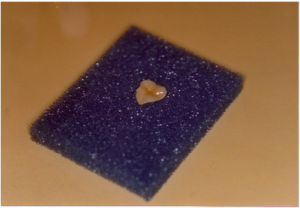 Inlay Onlay en céramique
