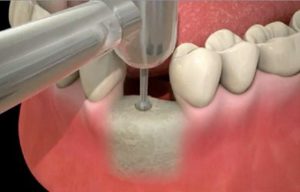 Mise en place de l’implant