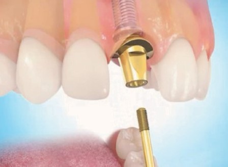 Prothèse dentaire sur implant dentiste richard amouyal Paris 16