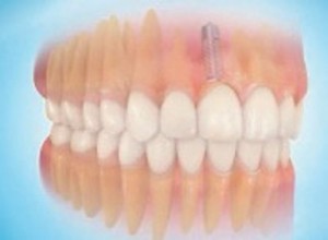 Prothèse dentaire terminée à paris dans le cabinet dentaire richard amouyal