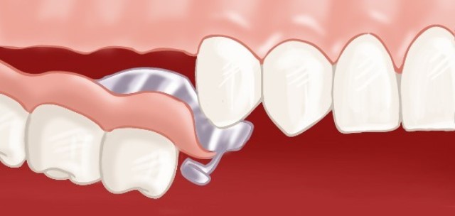 Prothèse dentaire amovible