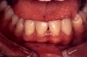 Correction d’espace par facette dentaire céramique