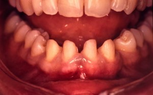 Correction d’espace par facette dentaire