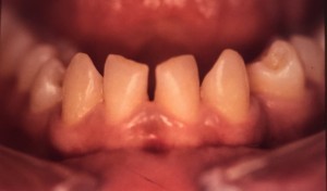 Correction d’espace dentaire par facette