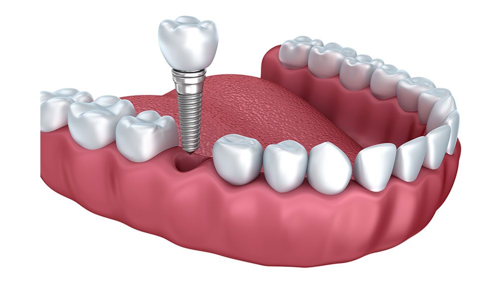 Implant dentaire dentiste richard amouyal Paris 16