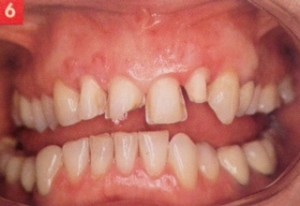 Vue des dents préparées pour les facettes en céramique