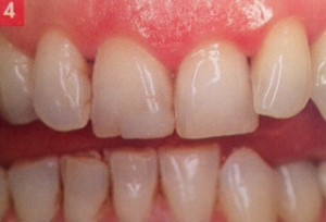 Composites inésthétiques remplacées par facettes dentaires