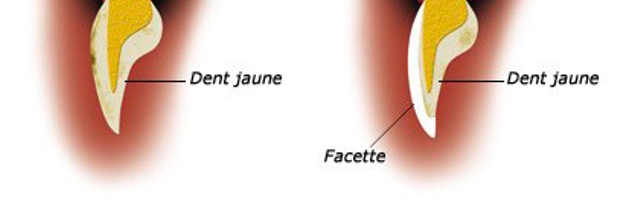 Les facettes céramiques dentiste Paris 16