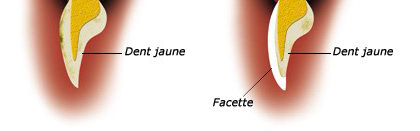 facettes céramique
