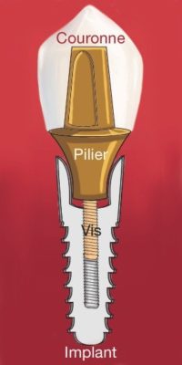 Schema implant dentaire dentiste amouyal paris 16