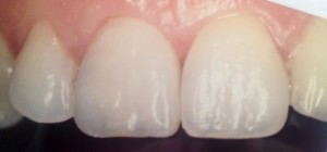 Après pose facette dentaire paris 16 dentiste Amouyal