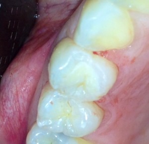 inlay onlay céramique Paris dentiste amouyal