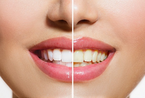 Détartrage des dents richard amouyal dentiste Paris 16