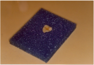 Inlay Onlay en céramique