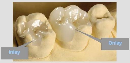 Inlay – Onlay céramique et composite dentiste amouyal paris 16