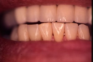 Bridge dentaire intégré à la gencive