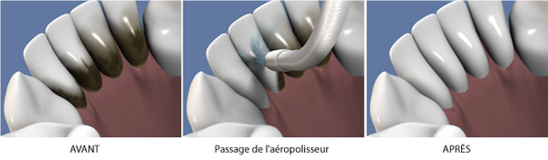 Detartrage à l'aeroplisseur