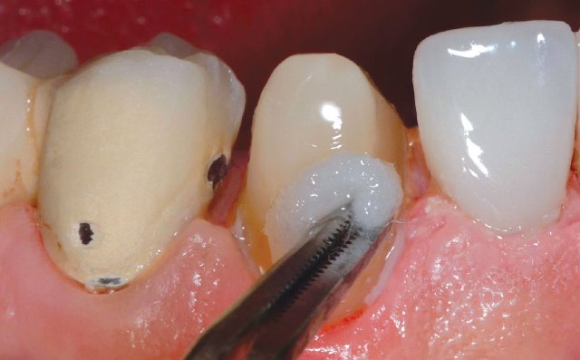 pose de Couronne dentaire : Restituer à l'identique une dent altérée