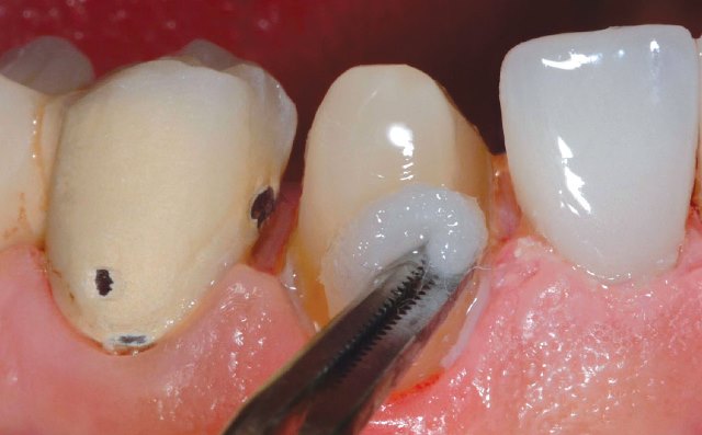 Reconstruire une dent abîmée: les matériaux dentiste paris 16