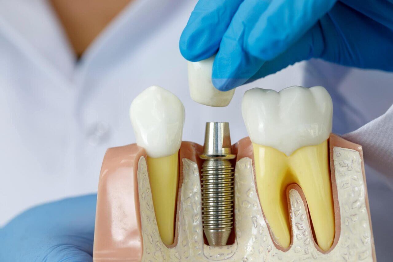 modele implant dentaire