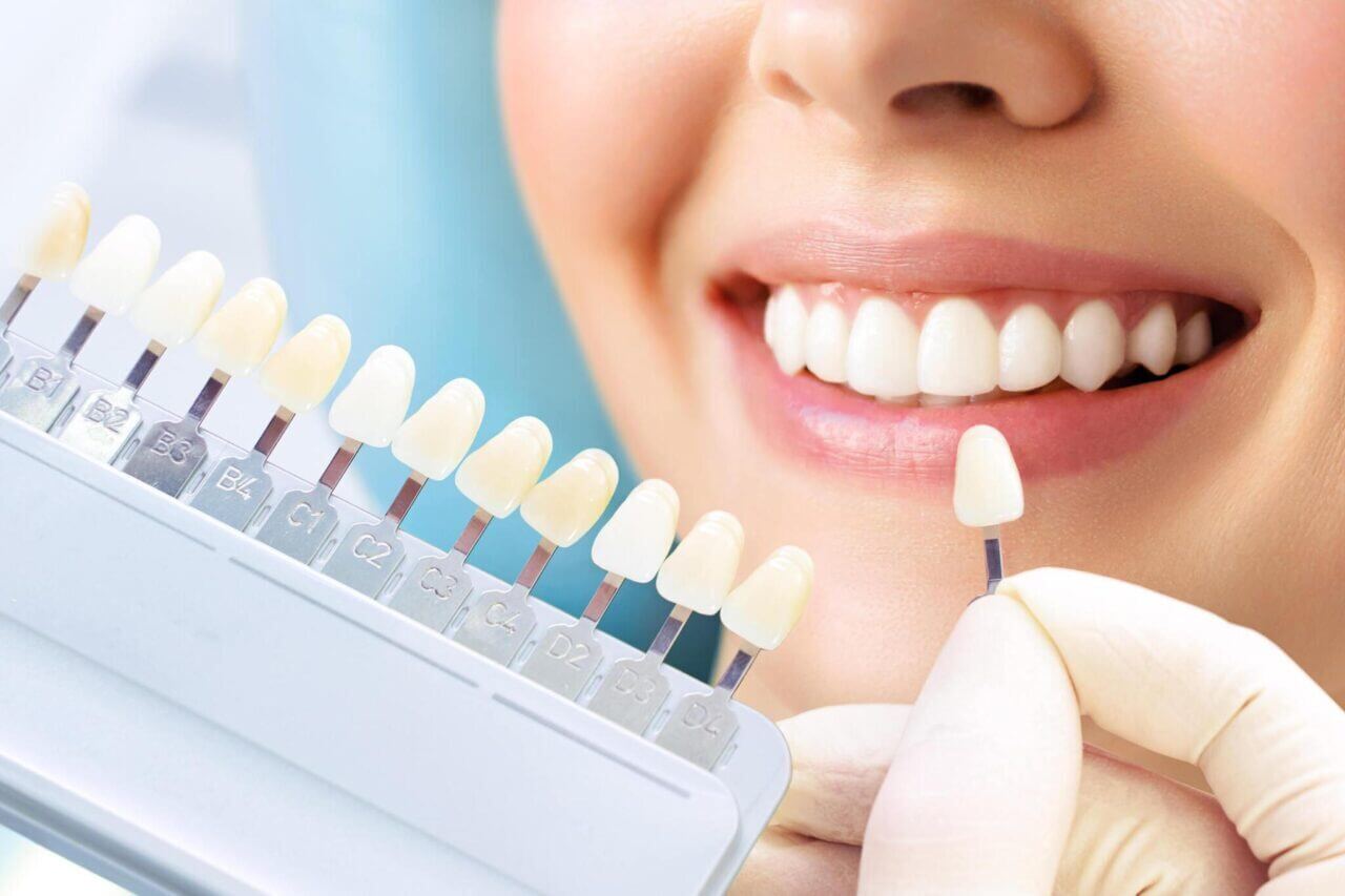 implants facettes dentaires