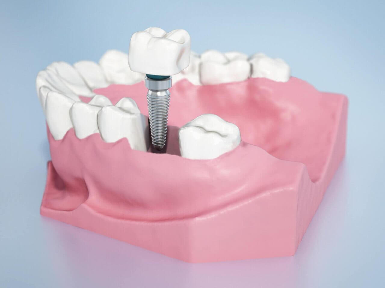 gencive implants dents