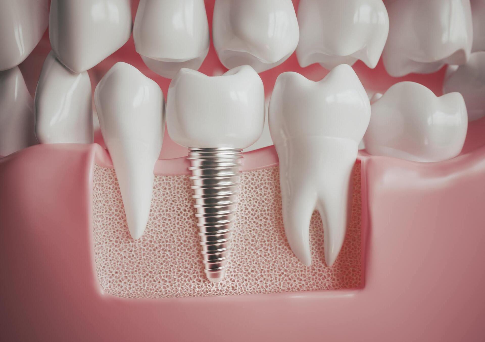 vue en coupe implants dentaires