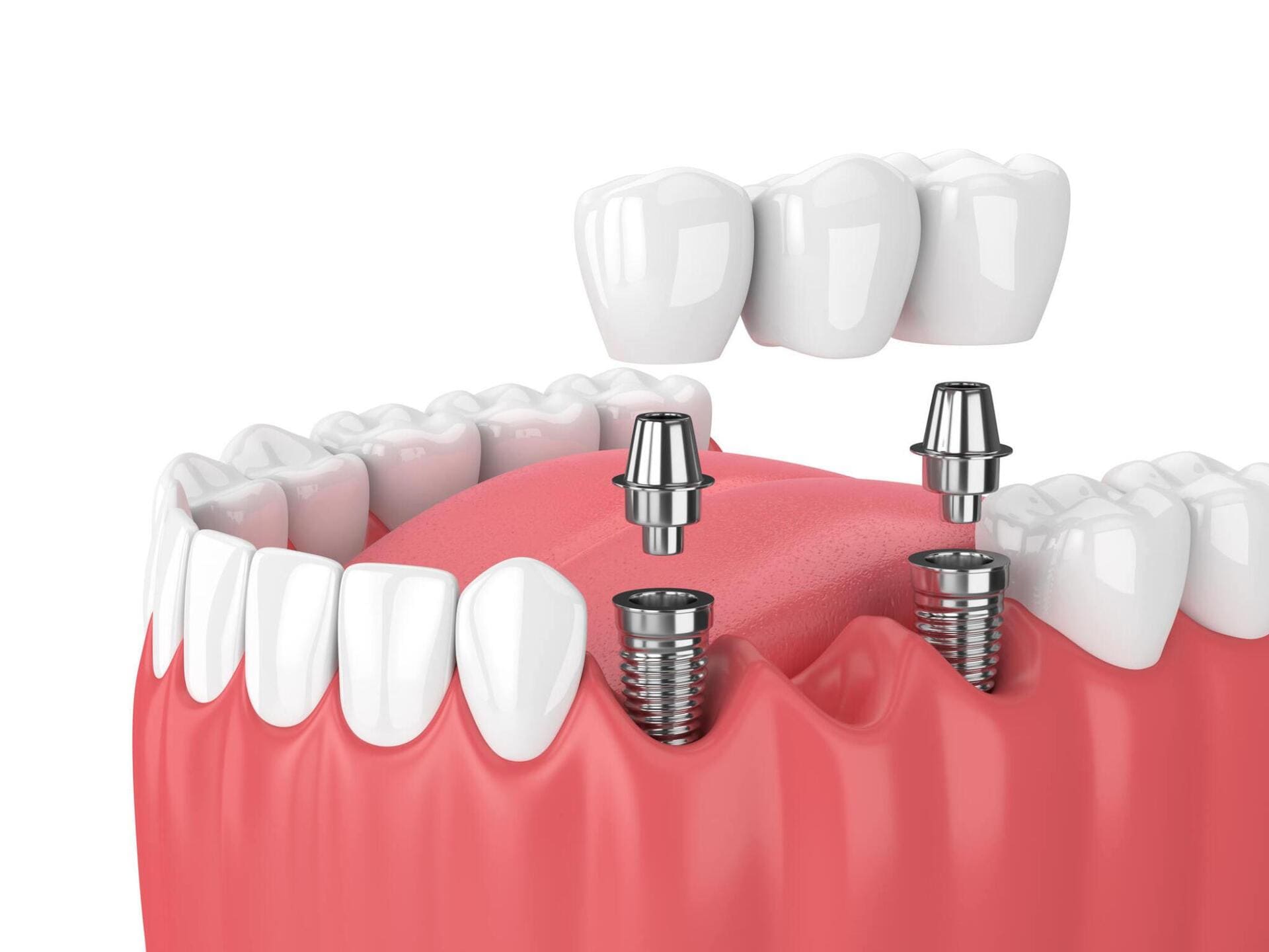 choisir implants dentaires