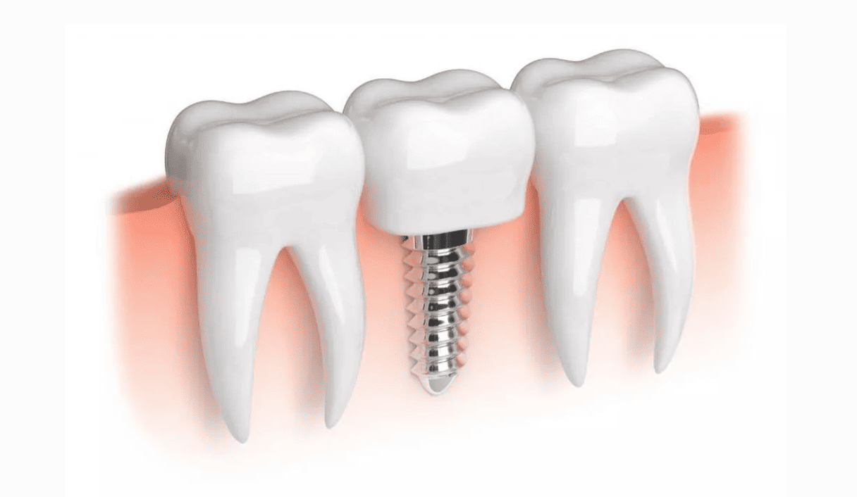 schema implants dentaires
